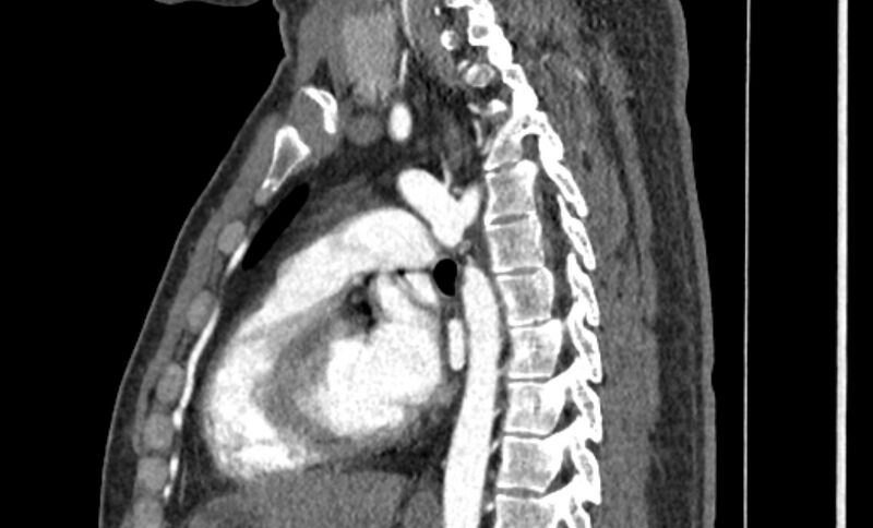 File:Coarctation of the aorta (Radiopaedia 53363-59343 B 36).jpg