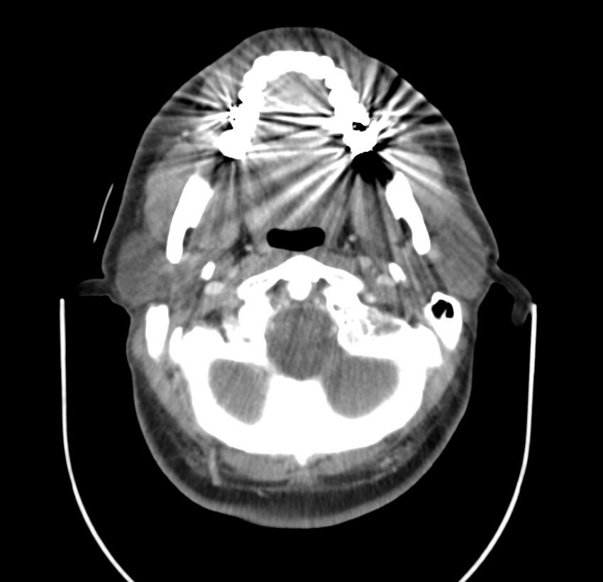 Colloid cyst of thyroid (Radiopaedia 22897-22923 Axial C+ delayed 20).jpg