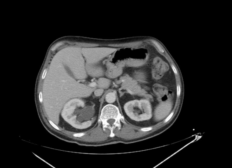 File:Colon cancer mimicking renal cell carcinoma (Radiopaedia 28986-29335 C 20).jpg