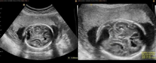 Fetal brain ultrasound scan at 36 weeks gestation: microcephaly