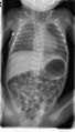 Esophageal atresia (Radiopaedia 20031).jpg