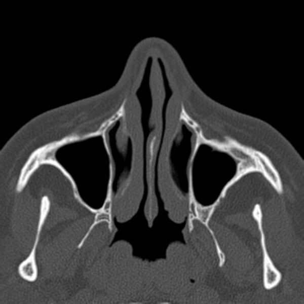 File:Nasolabial cyst (Radiopaedia 33987-35205 Axial bone window 14).jpg
