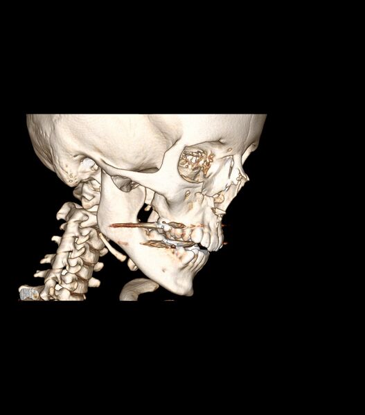 File:Nasoorbitoethmoid fracture (Radiopaedia 90044-107205 3D VRT 6).jpg
