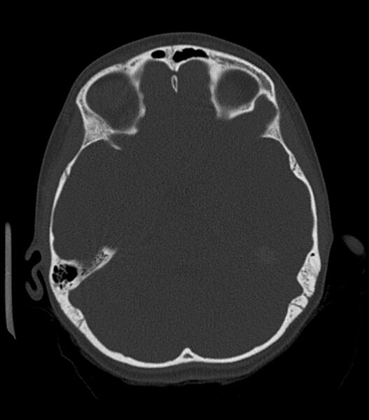 File:Nasoorbitoethmoid fracture (Radiopaedia 90044-107205 Axial bone window 91).jpg