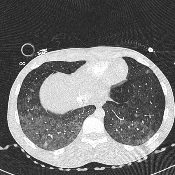 File:Near drowning (pulmonary edema) (Radiopaedia 24685-24958 lung window 68).jpg