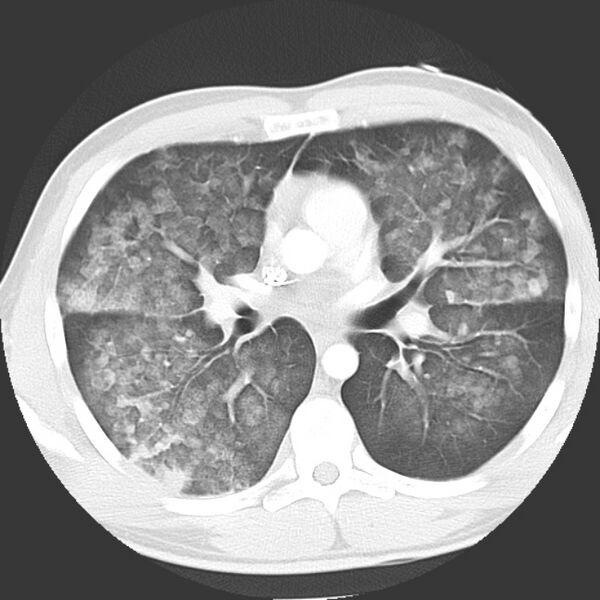 File:Near drowning pulmonary edema (Radiopaedia 16868-16591 Axial lung window 22).jpg