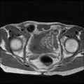 Necrotizing epididymo-orchitis with intra-testicular abscess (Radiopaedia 29397-29860 Axial T1 1).jpg