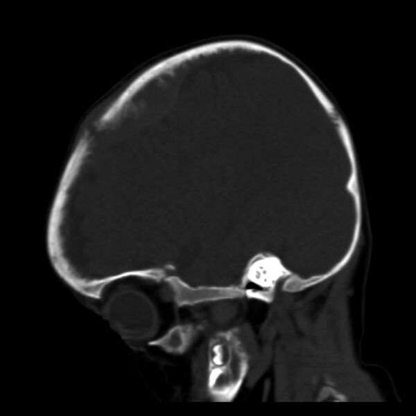 File:Neuroblastoma with skull metastases (Radiopaedia 30326-30958 Sagittal bone window 12).jpg
