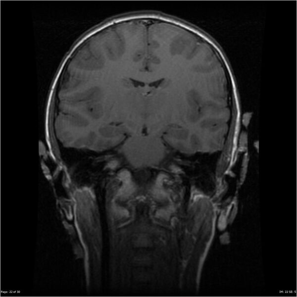 File:Neurofibromatosis type 1 (Radiopaedia 22541-22564 Coronal T1 31).jpg