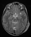 Neurofibromatosis type 1 (Radiopaedia 6954-8063 Axial T2 6).jpg
