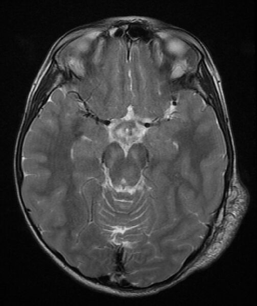 File:Neurofibromatosis type 1 (Radiopaedia 6954-8063 Axial T2 6).jpg