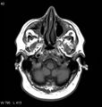Neurosarcoidosis (Radiopaedia 10930-11351 Axial T1 2).jpg