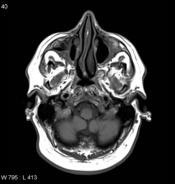 File:Neurosarcoidosis (Radiopaedia 10930-11351 Axial T1 2).jpg