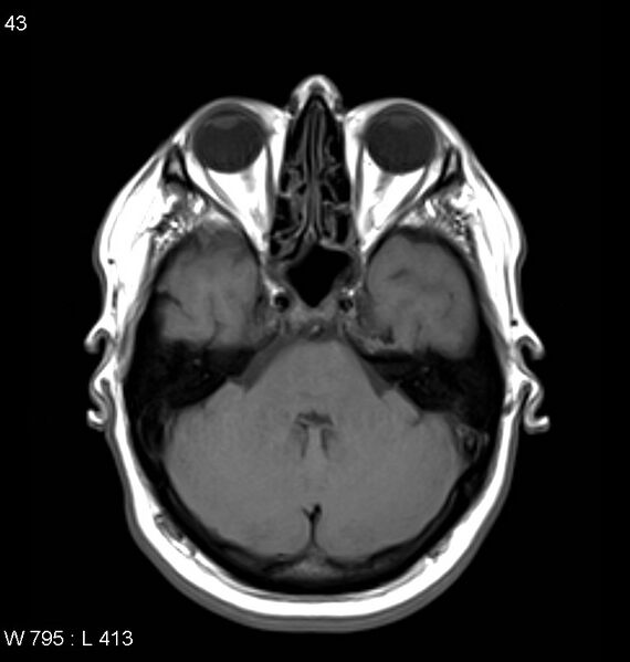 File:Neurosarcoidosis (Radiopaedia 10930-11351 Axial T1 5).jpg