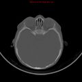Non-accidental injury - bilateral subdural with acute blood (Radiopaedia 10236-10765 Axial bone window 8).jpg