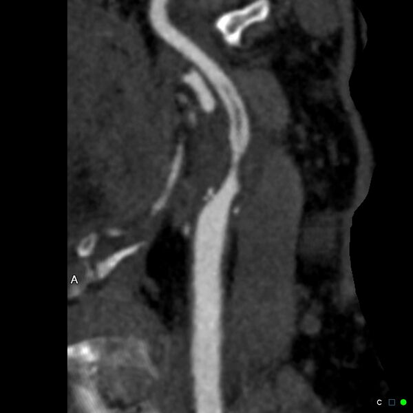File:Non-occlusive intraluminal internal carotid artery thrombus (Radiopaedia 37751-39658 A 47).jpg