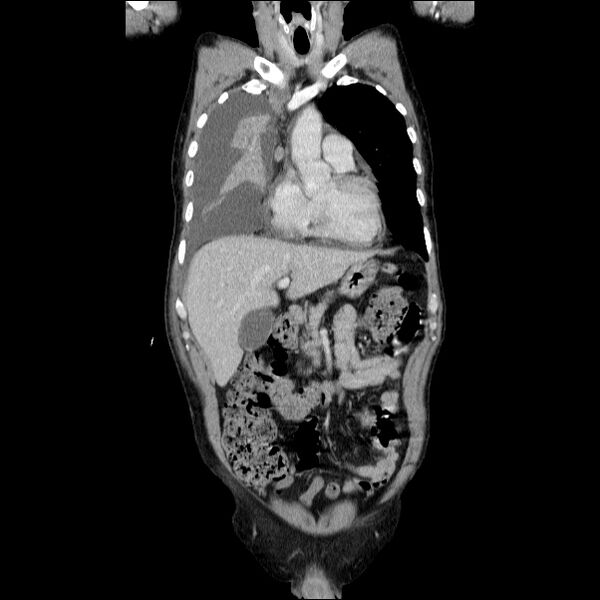 File:Non small-cell lung cancer (Radiopaedia 24467-24769 Coronal C+ delayed 20).jpg
