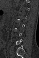 Normal CT lumbar spine (Radiopaedia 53981-60118 Sagittal bone window 70).jpg