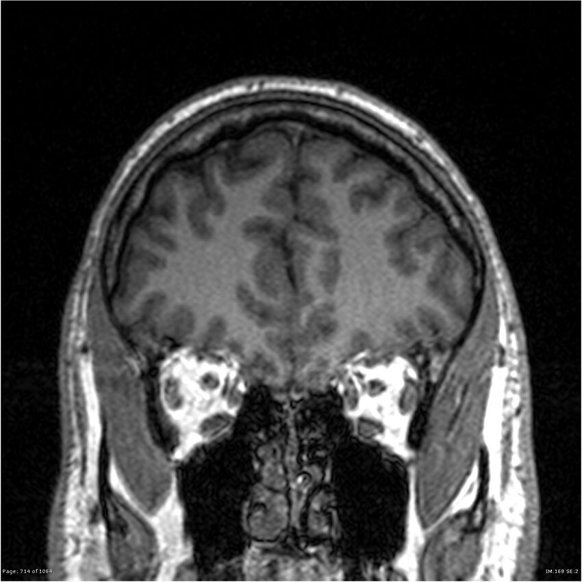 Normal brain MRI (non-focal epilepsy protocol) (Radiopaedia 38571-40700 Coronal T1 83).jpg