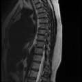 Normal cervical and thoracic spine MRI (Radiopaedia 35630-37156 G 5).png