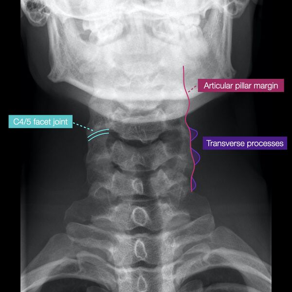 File:Normal cervical spine radiographs (Radiopaedia 32505-96697 B 3).jpeg