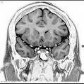 Normal coronal brain (Radiopaedia 6676-7910 B 15).jpg