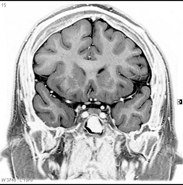 File:Normal coronal brain (Radiopaedia 6676-7910 B 15).jpg