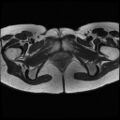 Normal female pelvis MRI (retroverted uterus) (Radiopaedia 61832-69933 Axial T2 27).jpg
