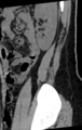 Normal lumbar spine CT (Radiopaedia 46533-50986 C 7).png