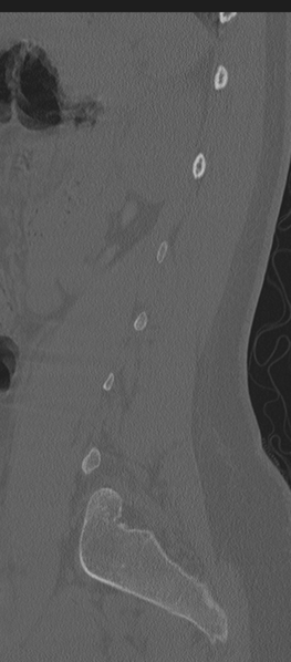 File:Normal lumbosacral CT (Radiopaedia 37923-39867 Sagittal bone window 25).png