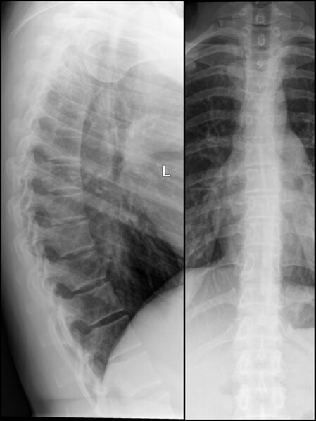 File:Normal thoracic spine (Radiopaedia 40136-52180 A 1).jpg