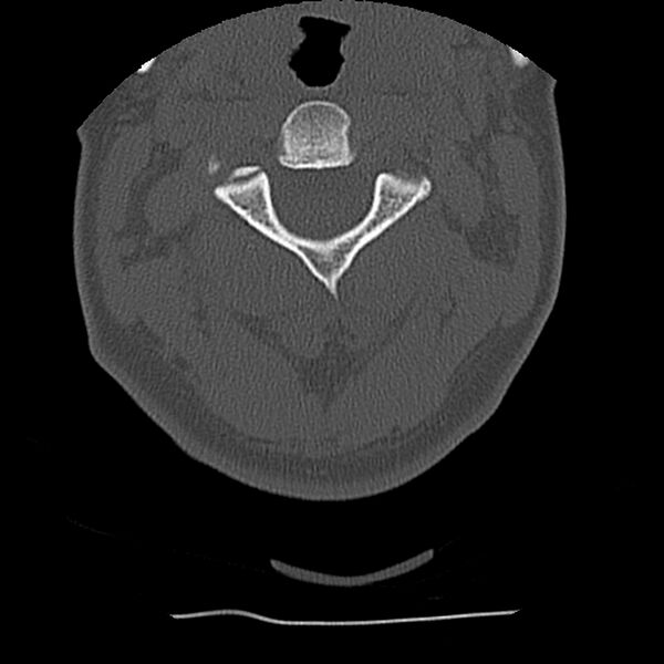 File:Normal trauma spine imaging (Radiopaedia 31753-32686 Axial bone window 22).jpg