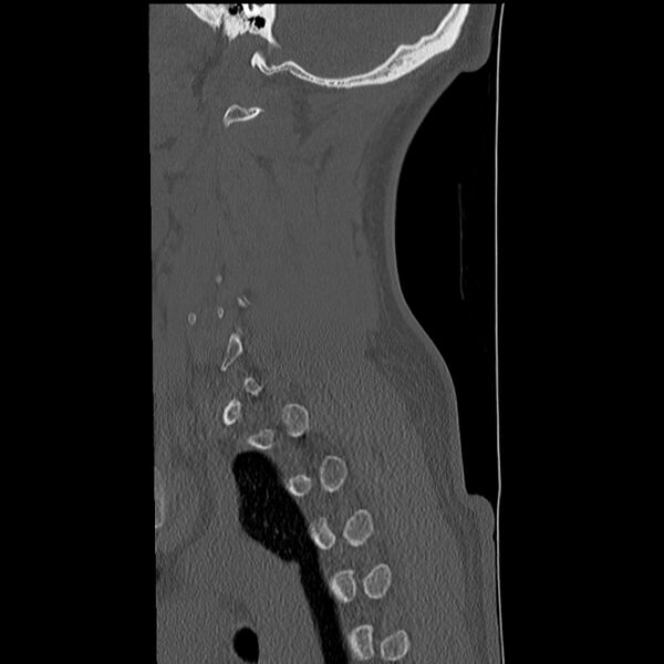 File:Normal trauma spine imaging (Radiopaedia 31753-32686 Sagittal bone window 35).jpg