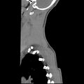 Normal trauma spine imaging (age 16) (Radiopaedia 45335-49358 C 1).jpg