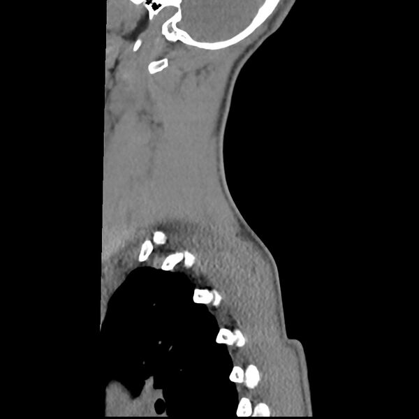 File:Normal trauma spine imaging (age 16) (Radiopaedia 45335-49358 C 1).jpg