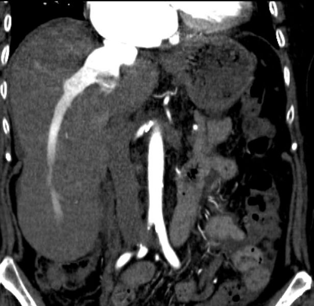 File:Nutmeg appearance of the liver (Radiopaedia 22879-35745 Coronal 1).jpg