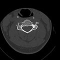 Occipital condyle fracture (Radiopaedia 31755-32691 Axial bone window 39).jpg