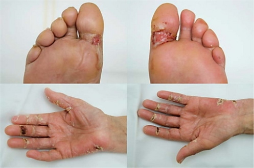 Blistering/ulceration of hands and feet