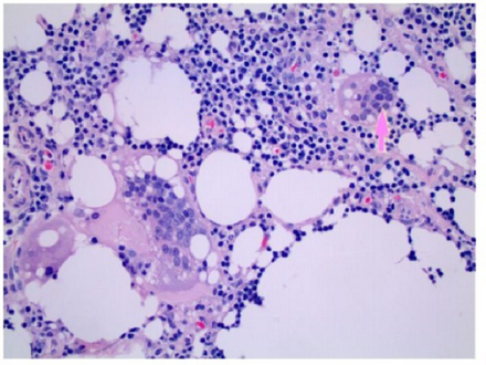 Silicone induced granuloma after injection for cosmetic purposes-Inguinal lymph node excisional biopsy shows giant cells