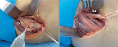 Surgery for radial neuropathy (RN) due to fibrotic cord (FC)