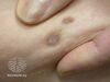 Pinch test (DermNet NZ doctors-dermoscopy-course-images-dimpling).jpg