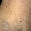 Seborrhoeic keratosis (DermNet NZ lesions-s-sebk-skintag).jpg