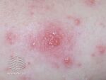 Vesicles due to eczema (DermNet NZ vesicles).jpg