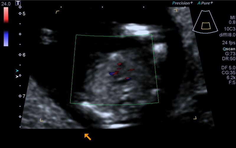 File:1st trimester nuchal-morphology ultrasound (Radiopaedia 44706-48477 Heart views cine with colour 134).jpg