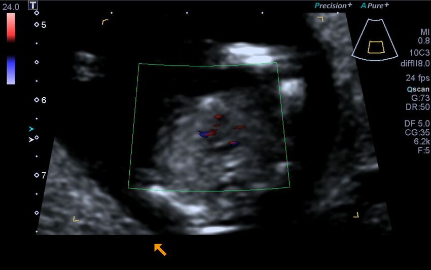 1st trimester nuchal-morphology ultrasound (Radiopaedia 44706-48477 Heart views cine with colour 134).jpg
