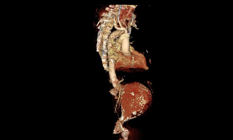 File:Abdominal aortic aneurysm- extremely large, ruptured (Radiopaedia 19882-19921 3D 22).jpg