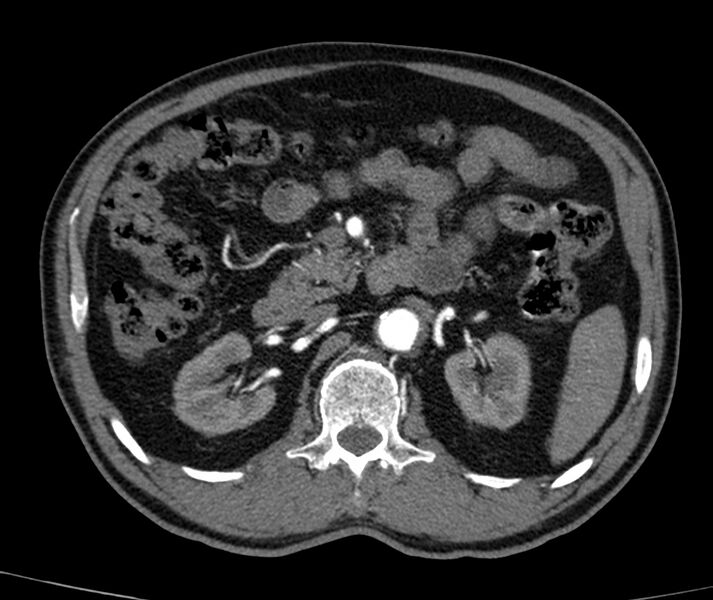 File:Abdominal aortic aneurysm (Radiopaedia 22421-22458 C+ arterial phase 28).jpg