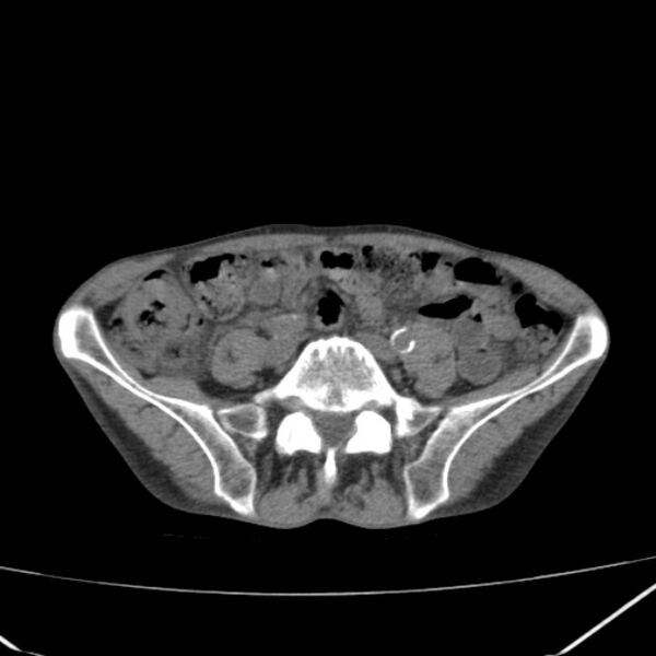 File:Abdominal aortic aneurysm (Radiopaedia 23703-23856 Axial non-contrast 38).jpg