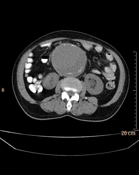 File:Abdominal aortic aneurysm (Radiopaedia 25985-26121 Axial non-contrast 12).jpg