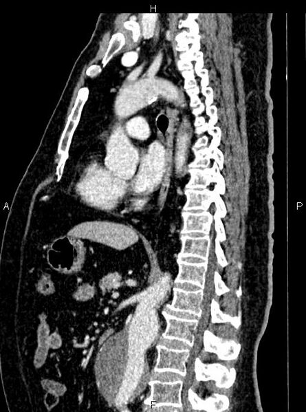 File:Abdominal aortic aneurysm (Radiopaedia 83094-97462 Sagittal renal cortical phase 67).jpg
